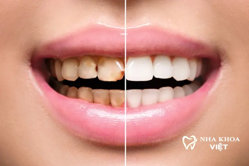 Dịch vụ Cạo Vôi Răng (Lấy Cao Răng)