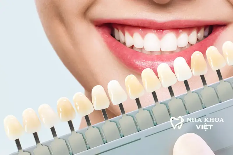 Dịch vụ Mặt Dán Sứ Veneer tại Nha khoa Việt