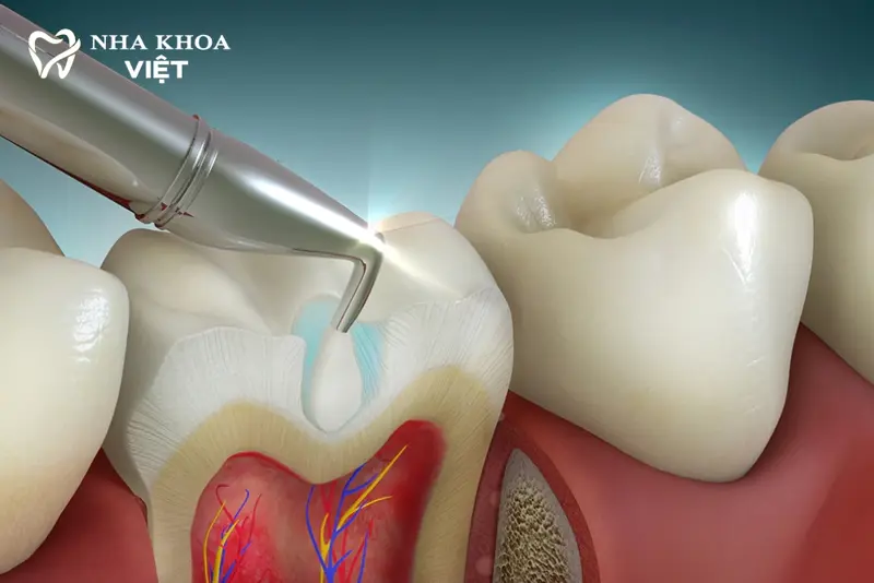 Dịch vụ Trám răng (Hàn răng)
