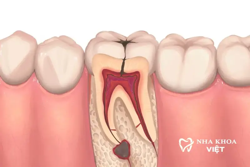 Điều trị nội nha: Chữa tủy, điều trị các bệnh lý tủy răng