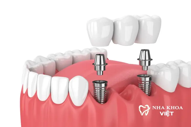 Trồng răng Implant là gì?
