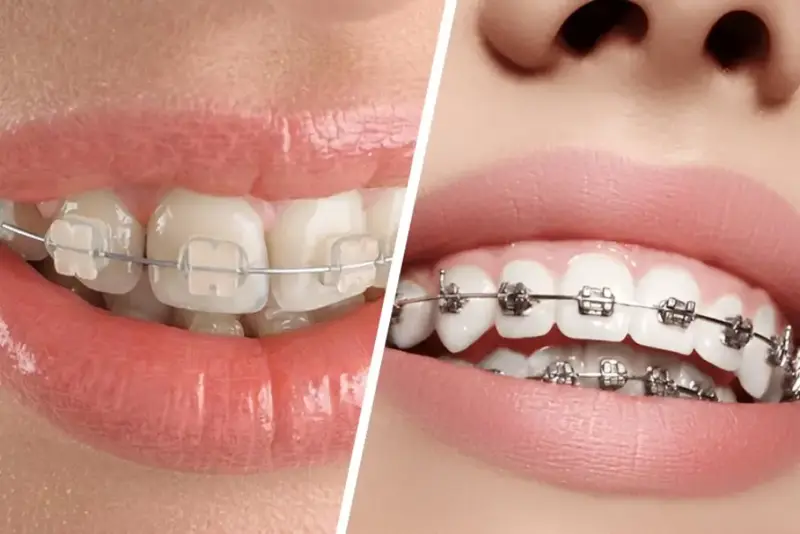 Niềng Răng Mắc Cài Kim Loại Phương pháp truyền thống chi phí rẻ tại Nha khoa Việt