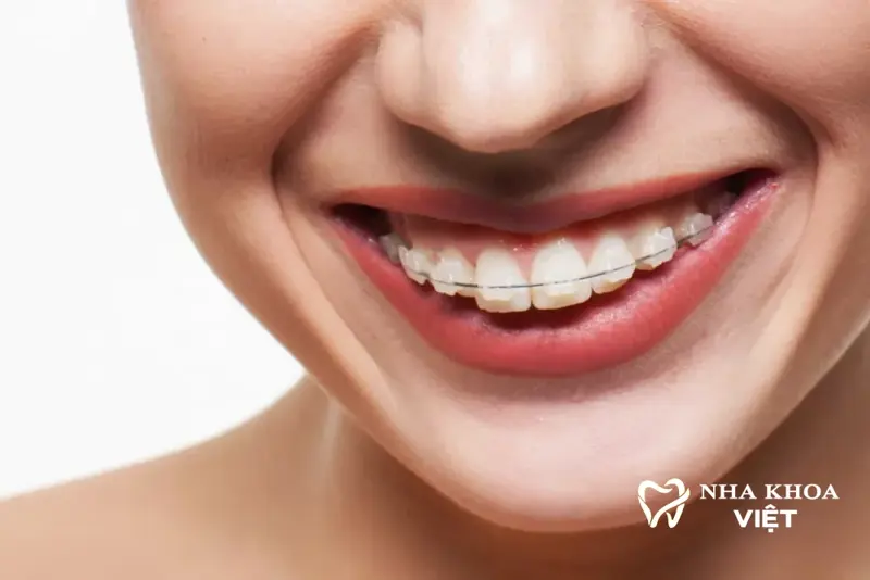 Niềng Răng Mắc Cài Sứ/Pha Lê tại Nha khoa Việt