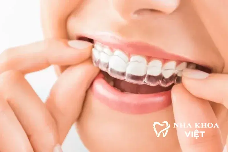 Niềng Răng Trong Suốt (Invisalign/Clear Aligner) tại Nha khoa Việt