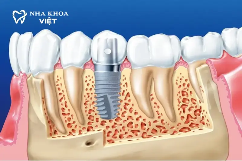 Ưu điểm vượt trội của phương pháp Implant tại Nha khoa Việt