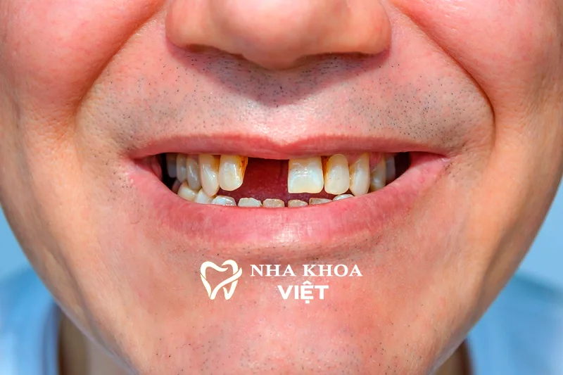 Những đối tượng nên trồng răng implant